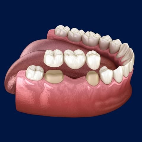 Dental bridge