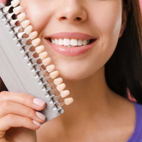 dental veneers