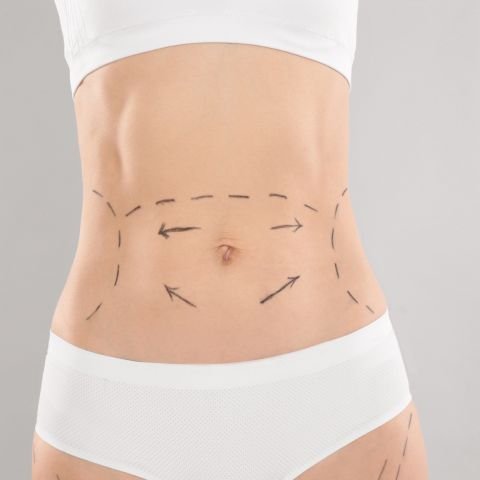 tummy tuck